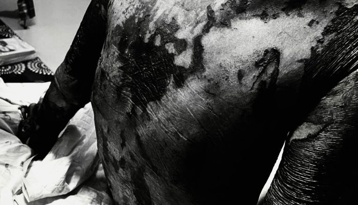 Heboh Dugaan Malpraktik RS AT Medika Palopo: Dari Keluhan Sakit Gusi Berujung Kematian